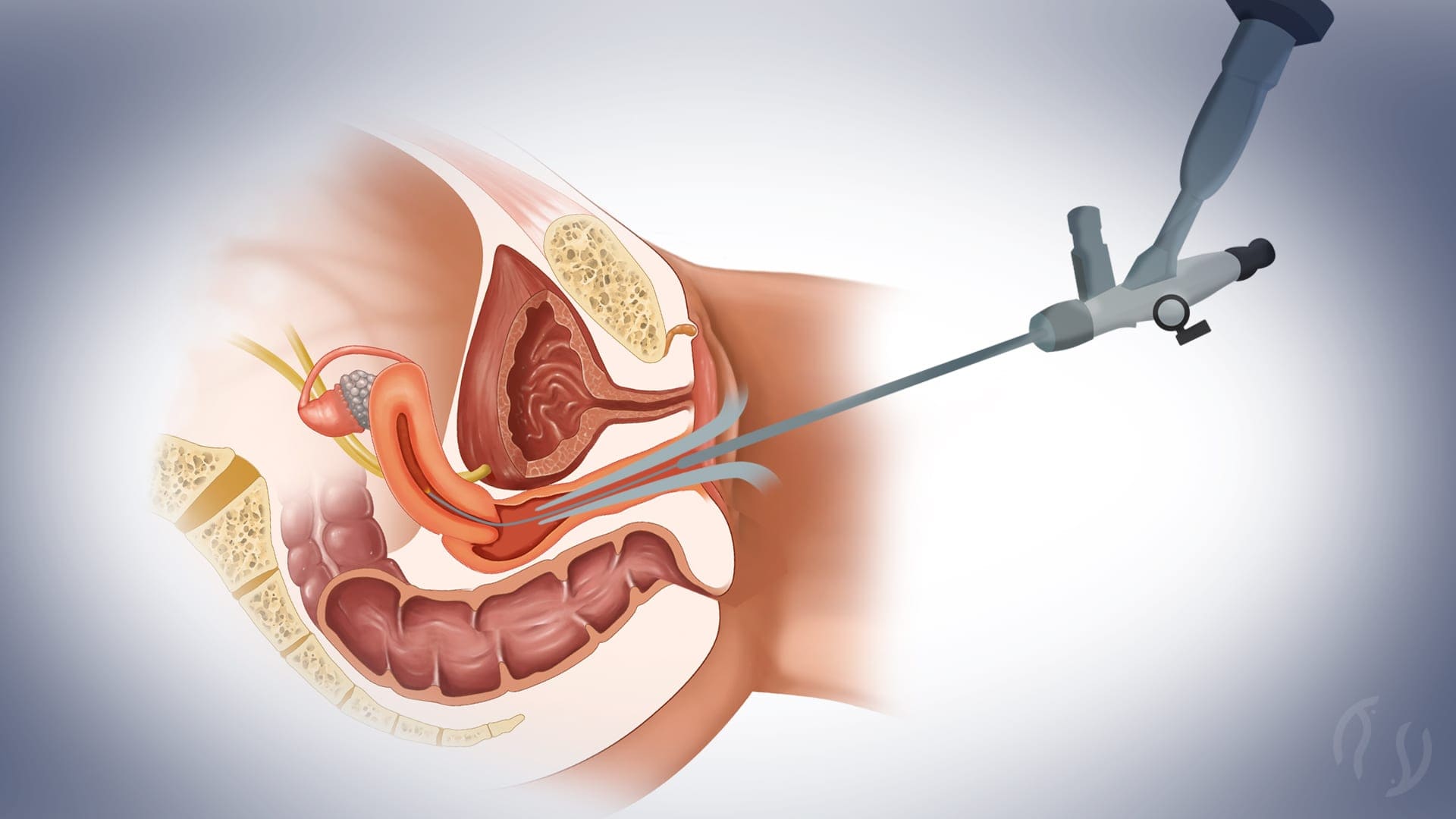 histeroscopia (acir)